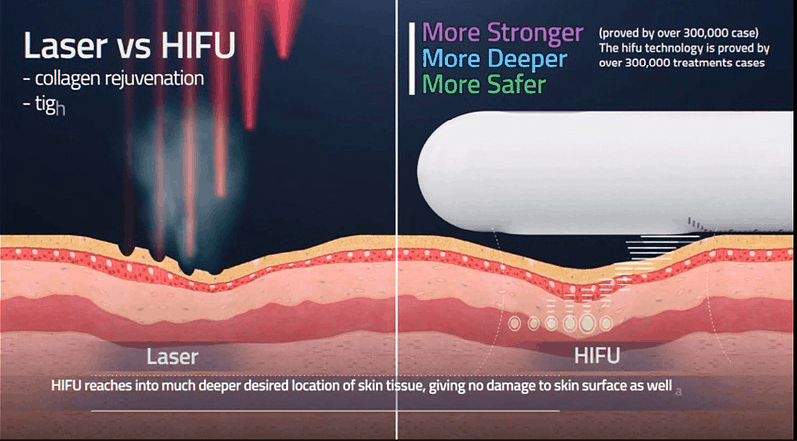 Hifu Vaginal Tightening Treatment Viva Concept Technology Co Ltd 