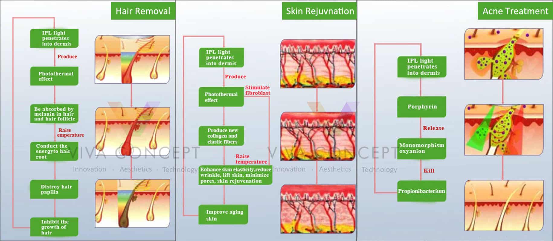 IPL hair removal machine application