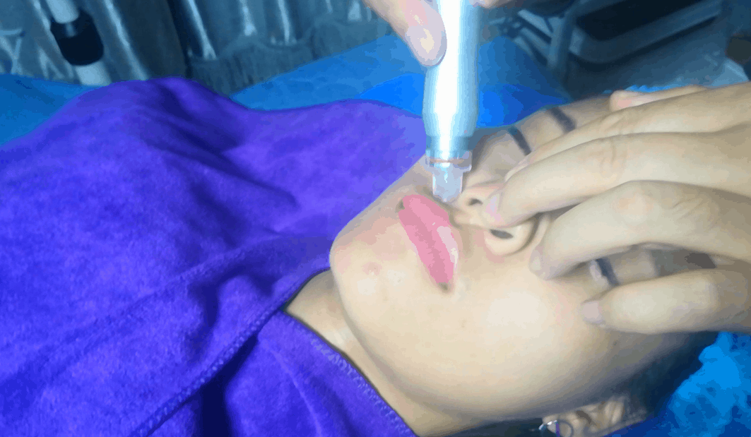 HydraFacial machine operation