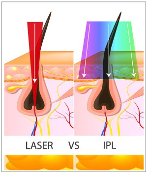 IPL VS Laser