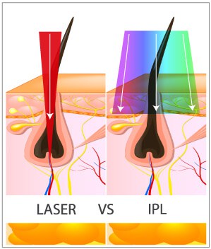 What is IPL hair removal? Differences to laser and how they both work