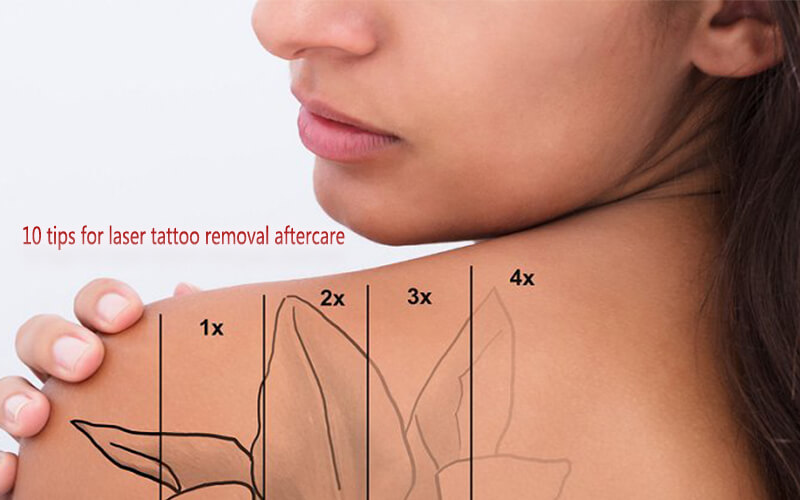 Proper Aftercare Instructions for Laser Tattoo Removal  Rochester Tattoo  Removal
