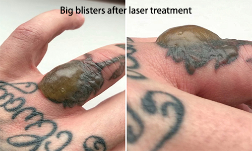 tattoo removal blisters care