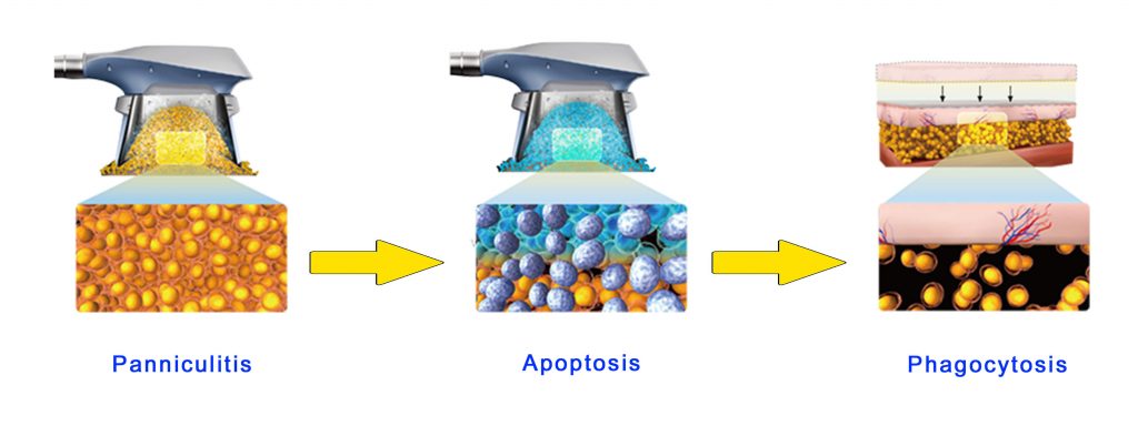 Mechanism for freezing fat removal