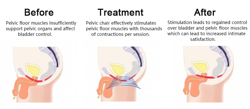 Pelvic treatment before and after for men