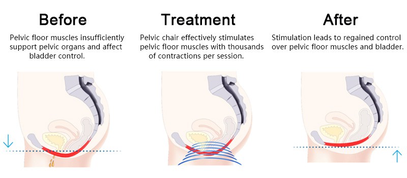 Pelvic treatment before and after
