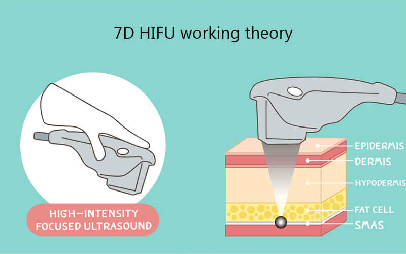 7D HIFU working theory