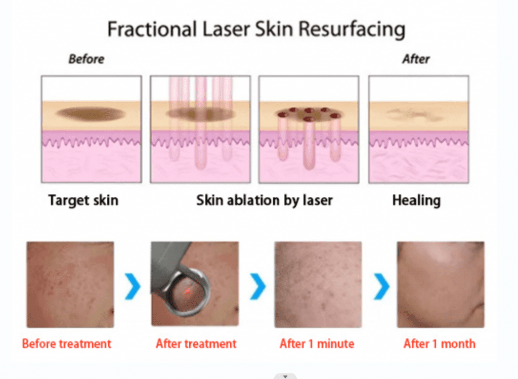 co2 laser procedure
